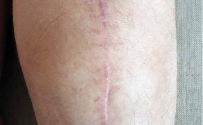 RWP_4_21_Agnieszka_Drozd_TERAPIA_MANUALNA_OBSZAR_BLIZNY_FOT_3