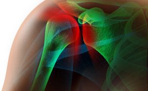 RWP_5-6_21_ARTROPLASTYKA_STAWU_RAMIENNEGO_iStock-459160509