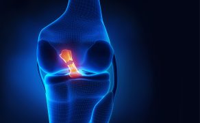 Artrometria jako obiektywna metoda w diagnostyce uszkodzeń więzadła krzyżowego przedniego