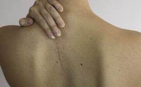 Znaczenie fizjoterapii w leczeniu blizn