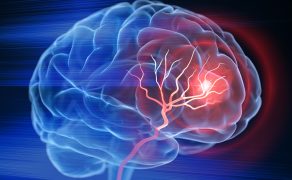 Terapia pozaustrojową falą uderzeniową w spastyczności u pacjentów po udarze mózgu