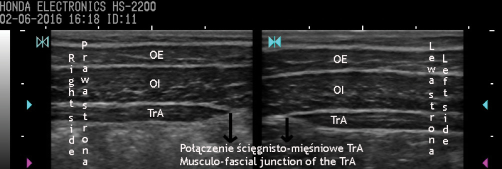 RWP_5_17_Pawel_Linek_USG_MORFOLOGIA_MIESNI_BOCZNEJ_SCIANY_BRZUCHA_RYC_1