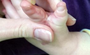 RWP_2_23_Jagoda_Walowska_REHABILITACJA_PACJENTKI_Z_SYNDAKTYLIA_FOT_4