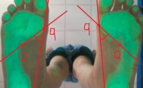 Wpływ występowania kręczu szyjnego na prawidłowe obciążenie kończyn dolnych – terapia z zastosowaniem technik terapii manualnej