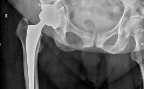 RWP_4_24_wiedza_w_praktyce_Kamil_Klupinski_ALLOPLASTYKA_STAWU_BIODROWEGO_FOT_2_A