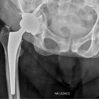 RWP_4_24_wiedza_w_praktyce_Kamil_Klupinski_ALLOPLASTYKA_STAWU_BIODROWEGO_FOT_2_A