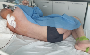 Fizjoterapia w przebiegu leczenia neurochirurgicznego przerzutu nowotworu germinalnego (2)