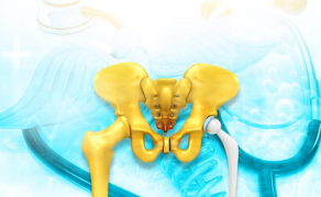 Kompleksowe postępowanie fizjoterapeutyczne po alloplastyce stawu biodrowego