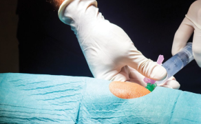 „Dostałem izotopy w kolano” – czyli pacjent po radiosynowiortezie stawu kolanowego