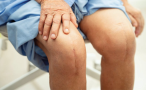 Obustronna całkowita endoprotezoplastyka stawu kolanowego a możliwości fizjoterapii