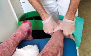 RWP_3_25_wiedza_w_praktyce_Renata_Sawicka_FIZJOTERAPIA_OPARZEN_CZ_2_FOT_36