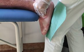 RWP_3_25_wiedza_w_praktyce_Renata_Sawicka_FIZJOTERAPIA_OPARZEN_CZ_2_FOT_50