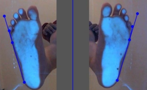 Analiza kątów alfa i beta u dzieci w wieku 5-16 lat w oparciu o badanie na podoskopie diagnostycznym