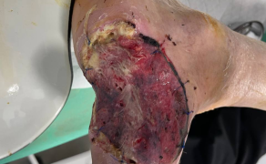 Fot. 2. Odleżyna boczna spowodowana niewystarczająco szerokim obuwiem u pacjenta z cukrzycą neuropatyczną. Stan po resekcji stopy cukrzycowej i autodermatoplastyce; źródło: archiwum autorów