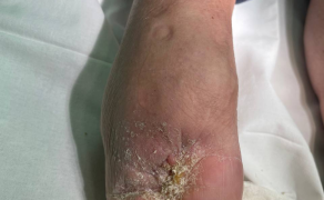 Fot. 3. Kikut po amputacji przygotowany do protezowania u pacjenta z cukrzycą typu II. Odleżyna w dystalnej części amputacji była spowodowana niewrażliwym przeszczepem skóry. Płytka AFO pękła, powodując ucisk i przemieszczenie wypełniacza przodostopia; źródło: archiwum autorów