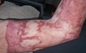 Postępowanie fizjoterapeutyczne po oparzeniu