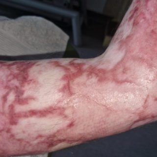 Postępowanie fizjoterapeutyczne po oparzeniu